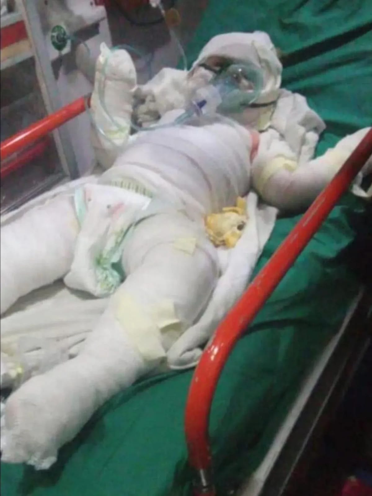 Un niño de 1 año y 9 meses lucha por su recuperación tras sufrir graves quemaduras en un incendio en Campo Grande